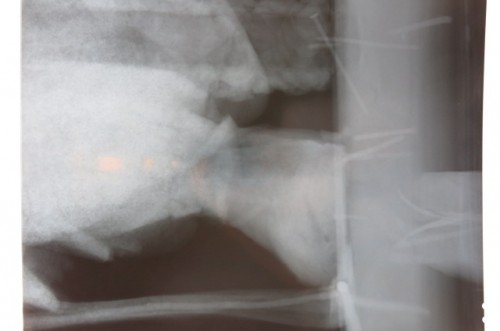 X-rays showing that interior wooden posts anchors foot to base with nails